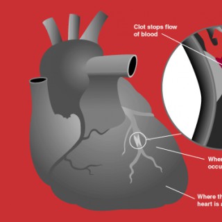 Acute coronary syndrome